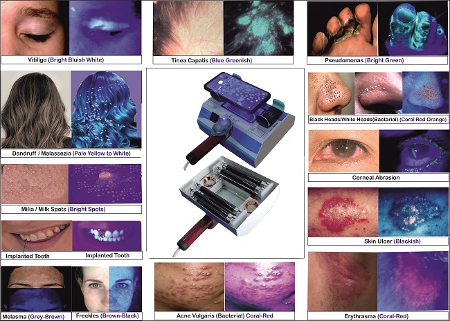 Woods Lamp for Skin Analyzer with Mobile & Remote attachment
